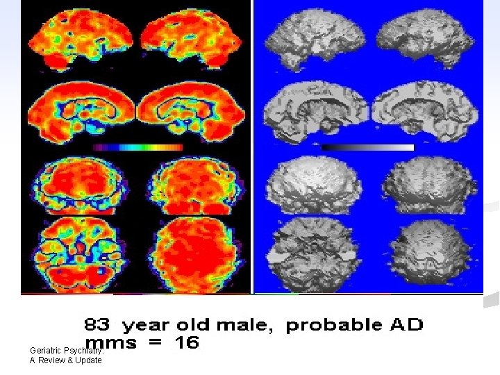 Geriatric Psychiatry: A Review & Update Geriatric Psychiatry: A Review & Update