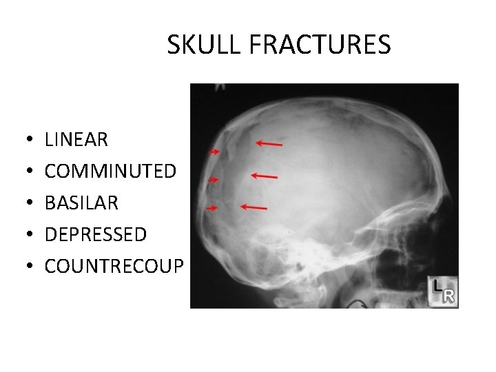 SKULL FRACTURES • • • LINEAR COMMINUTED BASILAR DEPRESSED COUNTRECOUP 