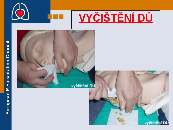 European Resuscitation Council VYČIŠTĚNÍ DÚ 