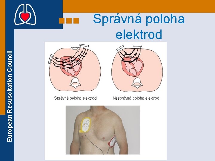 European Resuscitation Council Správná poloha elektrod 