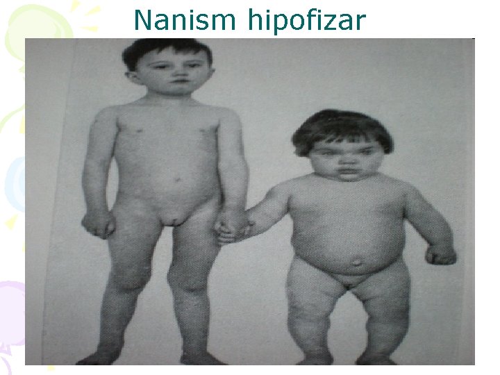 Nanism hipofizar 