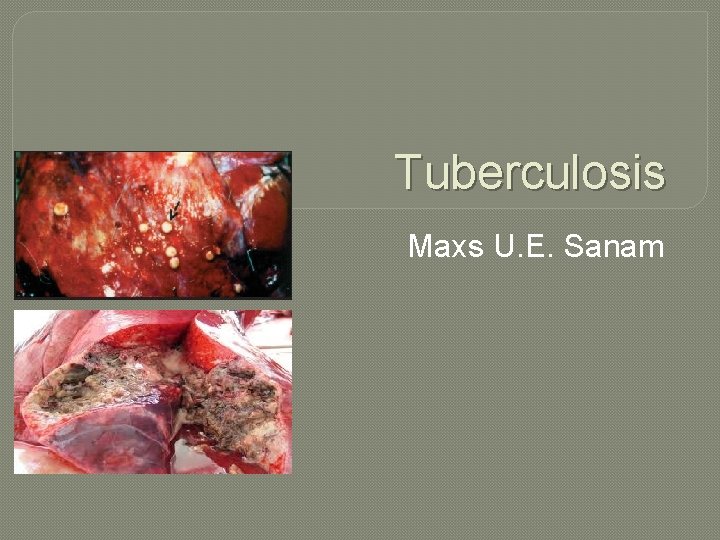 Tuberculosis Maxs U. E. Sanam 