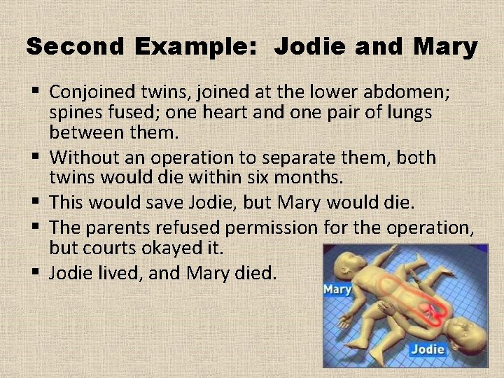 Second Example: Jodie and Mary § Conjoined twins, joined at the lower abdomen; spines