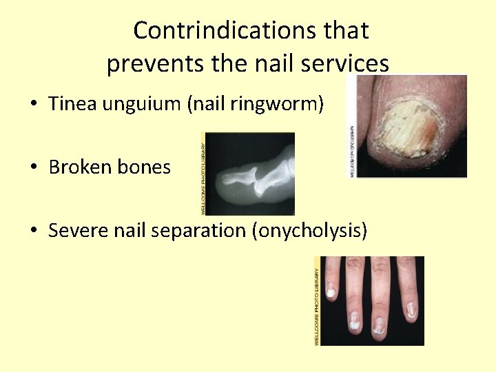 Contrindications that prevents the nail services • Tinea unguium (nail ringworm) • Broken bones
