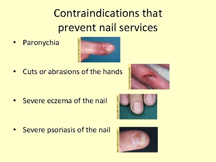 Contraindications that prevent nail services • Paronychia • Cuts or abrasions of the hands