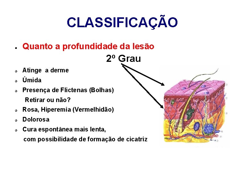 CLASSIFICAÇÃO ● Quanto a profundidade da lesão 2º Grau Atinge a derme Úmida Presença