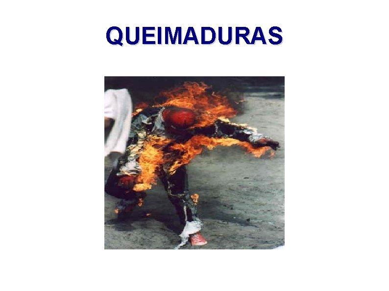 QUEIMADURAS 