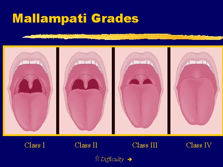 Mallampati Grades Class II Difficulty Class III Class IV 