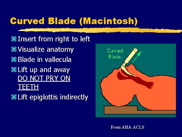 Curved Blade (Macintosh) z Insert from right to left z Visualize anatomy z Blade