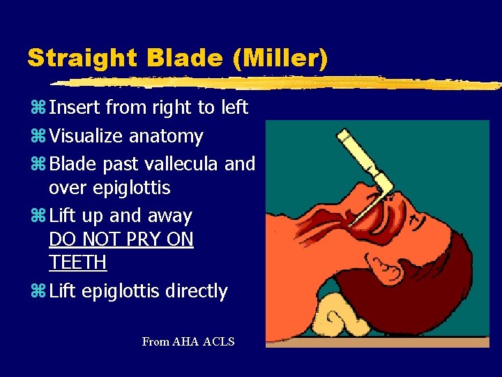 Straight Blade (Miller) z Insert from right to left z Visualize anatomy z Blade