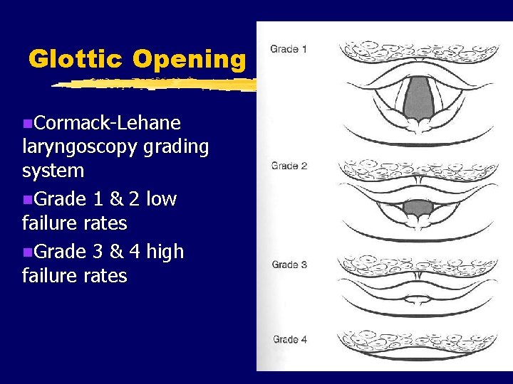 Glottic Opening n. Cormack-Lehane laryngoscopy grading system n. Grade 1 & 2 low failure