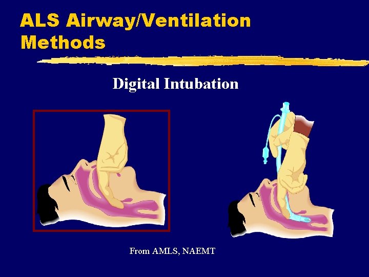 ALS Airway/Ventilation Methods Digital Intubation From AMLS, NAEMT 