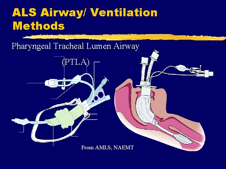 ALS Airway/ Ventilation Methods Pharyngeal Tracheal Lumen Airway (PTLA) From AMLS, NAEMT 