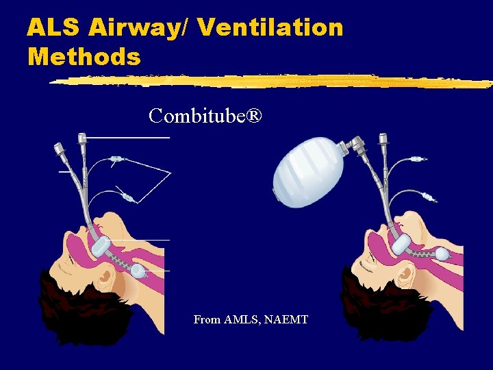 ALS Airway/ Ventilation Methods Combitube® From AMLS, NAEMT 