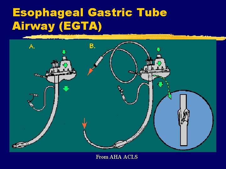 Esophageal Gastric Tube Airway (EGTA) From AHA ACLS 