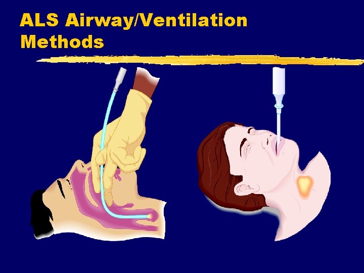 ALS Airway/Ventilation Methods 