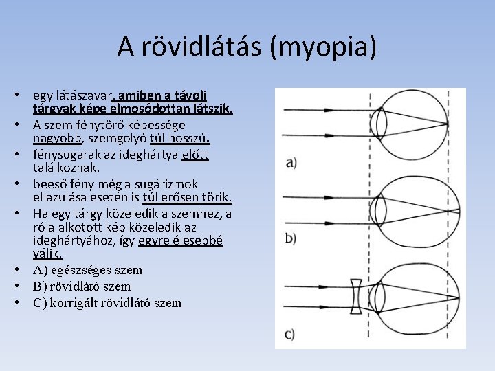 myopia egészséges szemek)