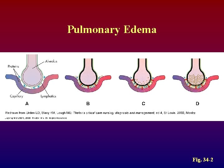 Pulmonary Edema Fig. 34 -2 