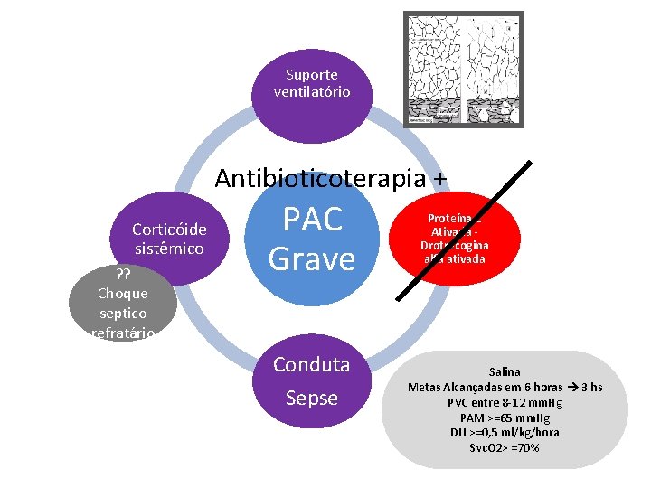 Suporte ventilatório Antibioticoterapia + Corticóide sistêmico ? ? Choque septico refratário PAC Grave Conduta