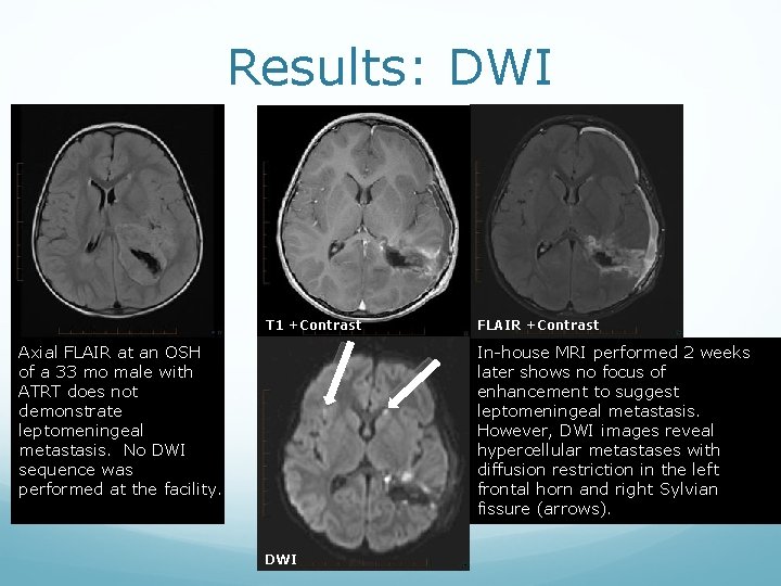Results: DWI T 1 +Contrast Axial FLAIR at an OSH of a 33 mo