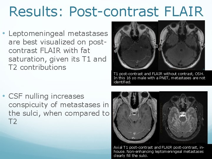 Results: Post-contrast FLAIR • Leptomeningeal metastases are best visualized on postcontrast FLAIR with fat