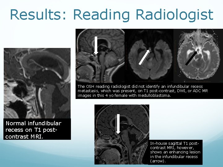 Results: Reading Radiologist The OSH reading radiologist did not identify an infundibular recess metastasis,