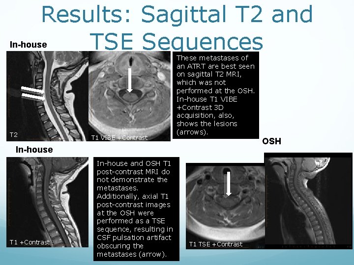 Results: Sagittal T 2 and TSE Sequences In-house T 2 T 1 VIBE +Contrast