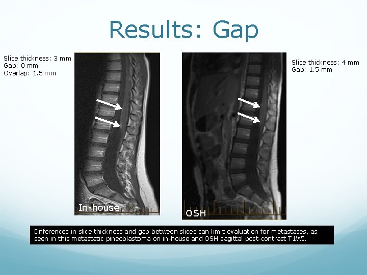 Results: Gap Slice thickness: 3 mm Gap: 0 mm Overlap: 1. 5 mm Slice