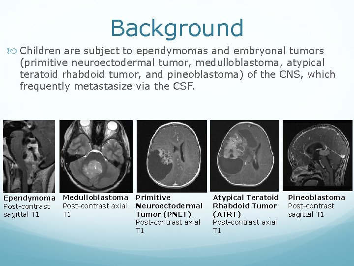Background Children are subject to ependymomas and embryonal tumors (primitive neuroectodermal tumor, medulloblastoma, atypical