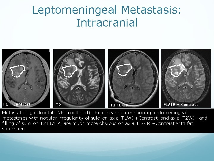 Leptomeningeal Metastasis: Intracranial T 1 + Contrast T 2 FLAIR + Contrast Metastatic right