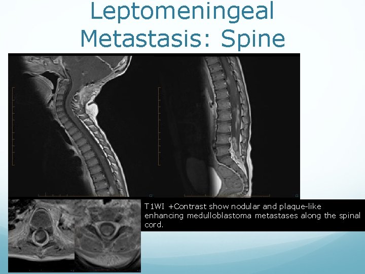 Leptomeningeal Metastasis: Spine T 1 WI +Contrast show nodular and plaque-like enhancing medulloblastoma metastases