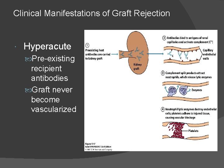 Clinical Manifestations of Graft Rejection Hyperacute Pre-existing recipient antibodies Graft never become vascularized 