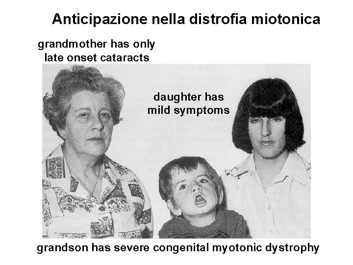 Anticipazione nella distrofia miotonica grandmother has only late onset cataracts daughter has mild symptoms