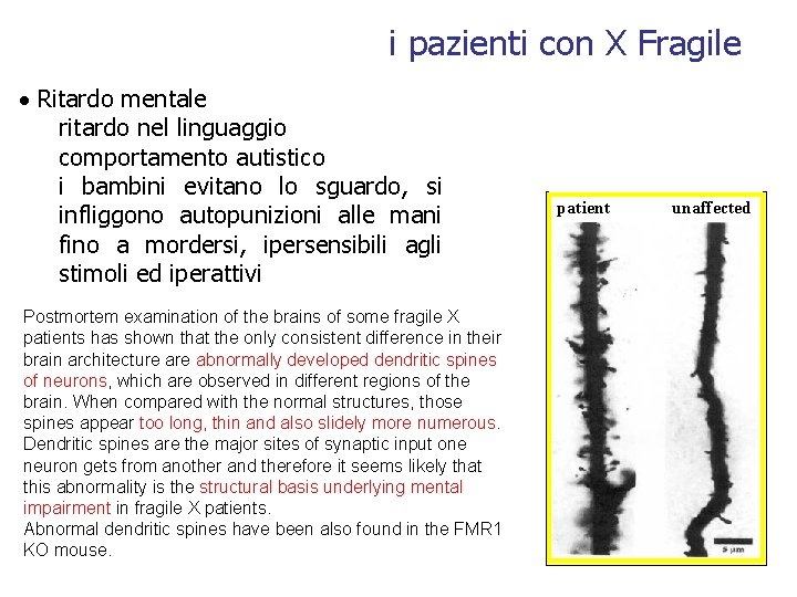 i pazienti con X Fragile Ritardo mentale ritardo nel linguaggio comportamento autistico i bambini