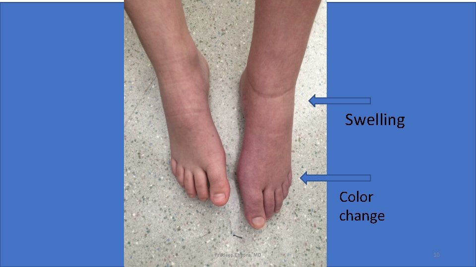 Swelling Color change Pradeep Chopra, MD 10 