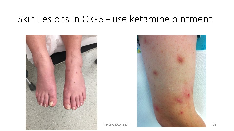 Skin Lesions in CRPS – use ketamine ointment Pradeep Chopra, MD 124 
