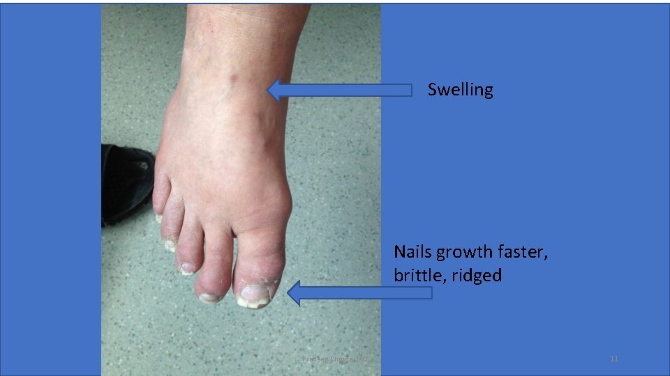 Swelling Nails growth faster, brittle, ridged Pradeep Chopra, MD 11 