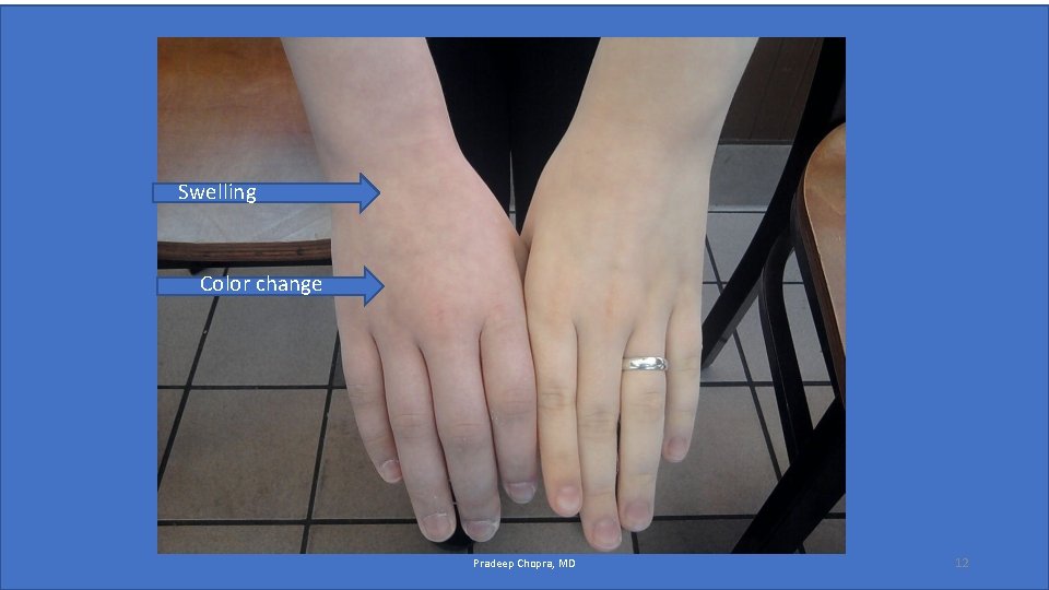 Swelling Color change Pradeep Chopra, MD 12 