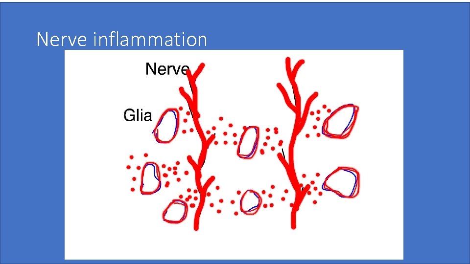 Nerve inflammation Pradeep Chopra, MD 