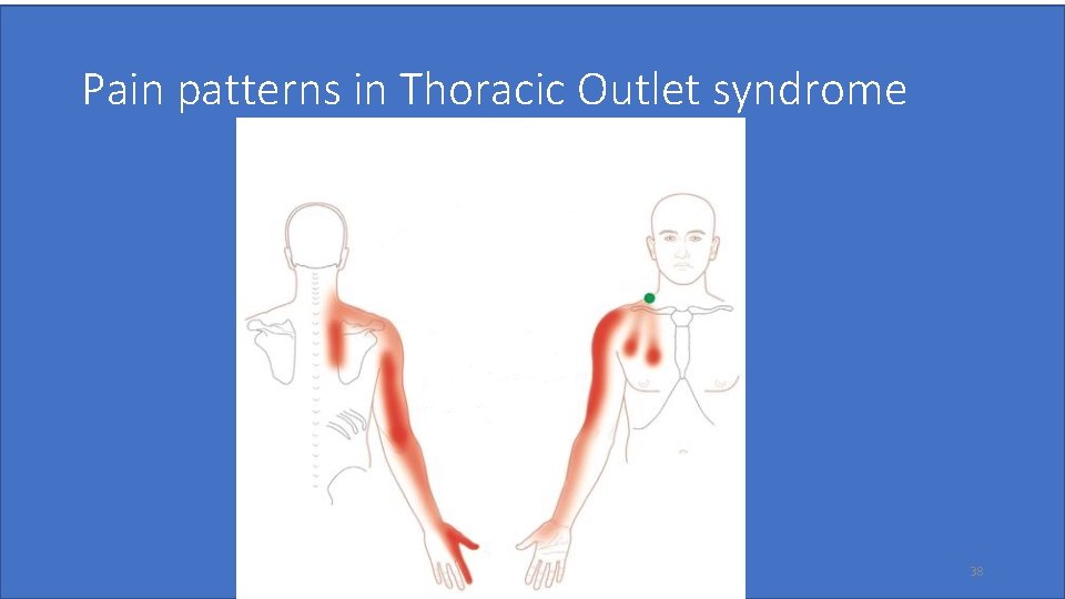 Pain patterns in Thoracic Outlet syndrome 38 