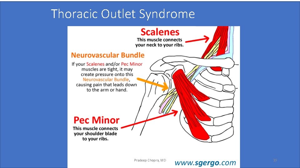 Thoracic Outlet Syndrome Pradeep Chopra, MD 39 