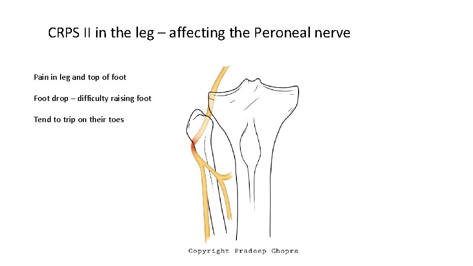 CRPS II in the leg – affecting the Peroneal nerve Pain in leg and