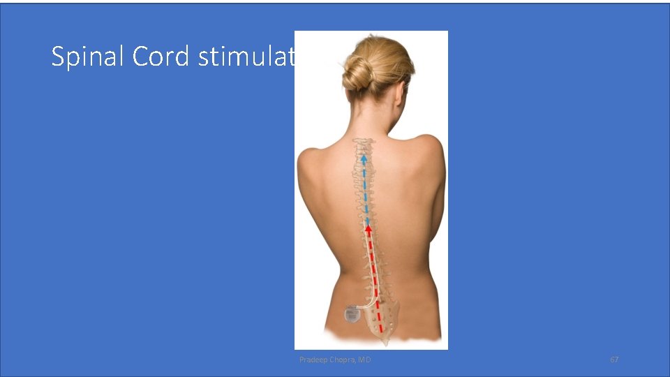 Spinal Cord stimulator Pradeep Chopra, MD 67 