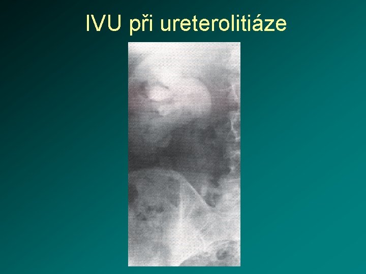 IVU při ureterolitiáze 