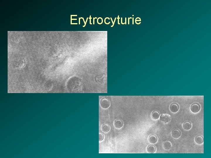 Erytrocyturie 