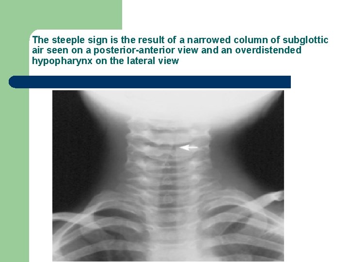 The steeple sign is the result of a narrowed column of subglottic air seen