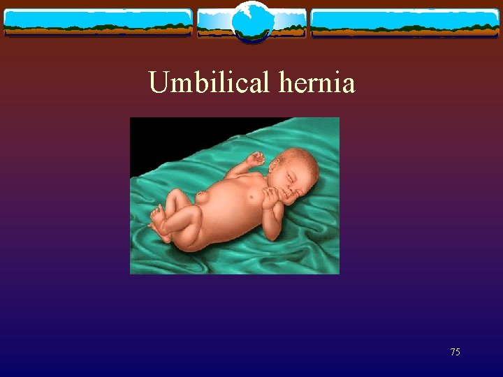 Umbilical hernia 75 