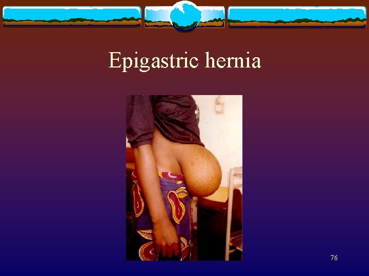 Epigastric hernia 76 