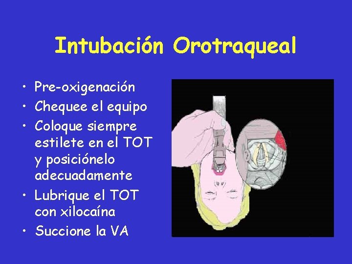 Intubación Orotraqueal • Pre-oxigenación • Chequee el equipo • Coloque siempre estilete en el