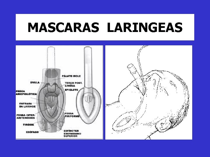 MASCARAS LARINGEAS 
